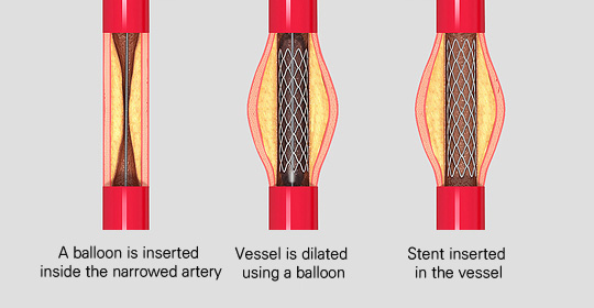 관상동맥 중재술 이미지
