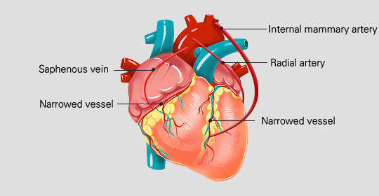 관상동맥 우회로술 이미지