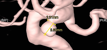 뇌동맥류 시술 전 이미지