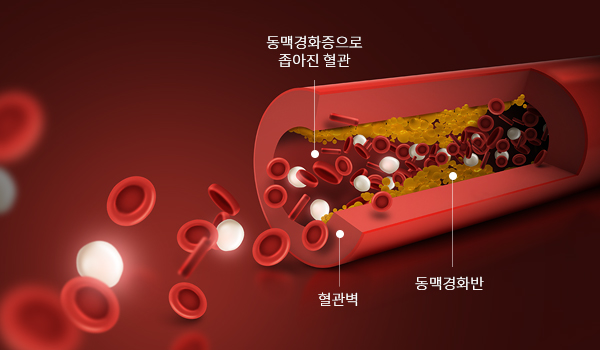 고지혈증 이미지