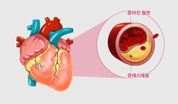 고지혈증 이미지