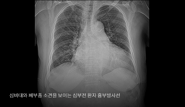 부정맥 이미지