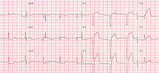 급성심근경색 심전도 이미지