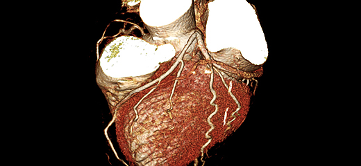 정상 관상동맥 CT 이미지