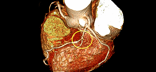 관상동맥에 이상이 있는 환자 CT 이미지