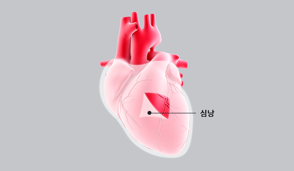 심낭천자술 삽입술 이미지