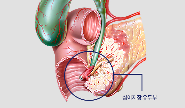 내시경 역행 췌담관 조영술 이미지