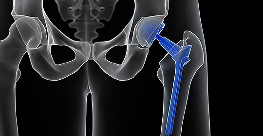 고관절 인공관절 치환술 이미지