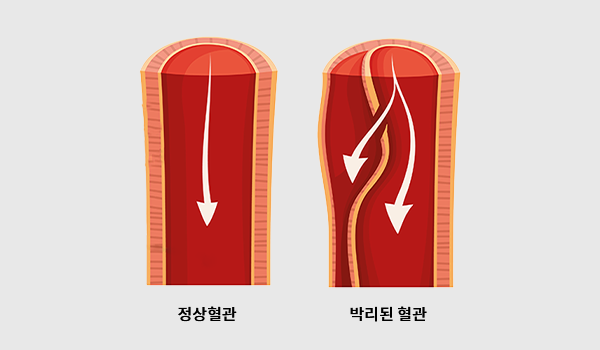대동맥박리 이미지