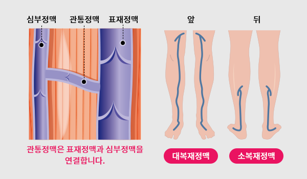 하지정맥류 이미지