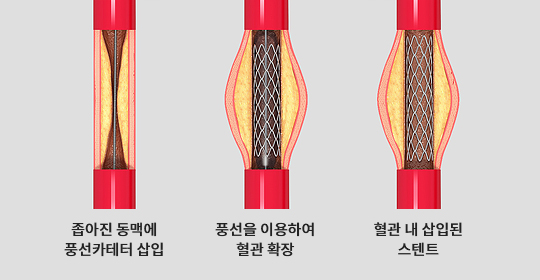 관상동맥 중재술 이미지