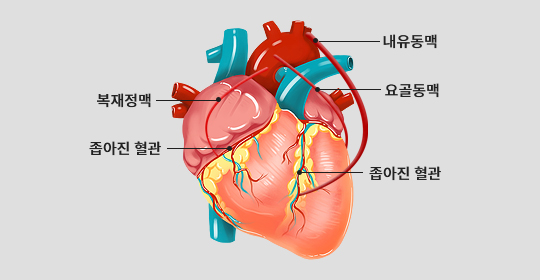 관상동맥 우회로술 이미지