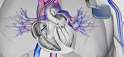 인공심박동기 시술방법 이미지1
